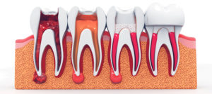 root canal treatment guildford